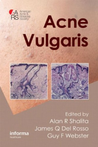 Alan R. Shalita, James Q. Del Rosso, Guy Webster — Acne Vulgaris